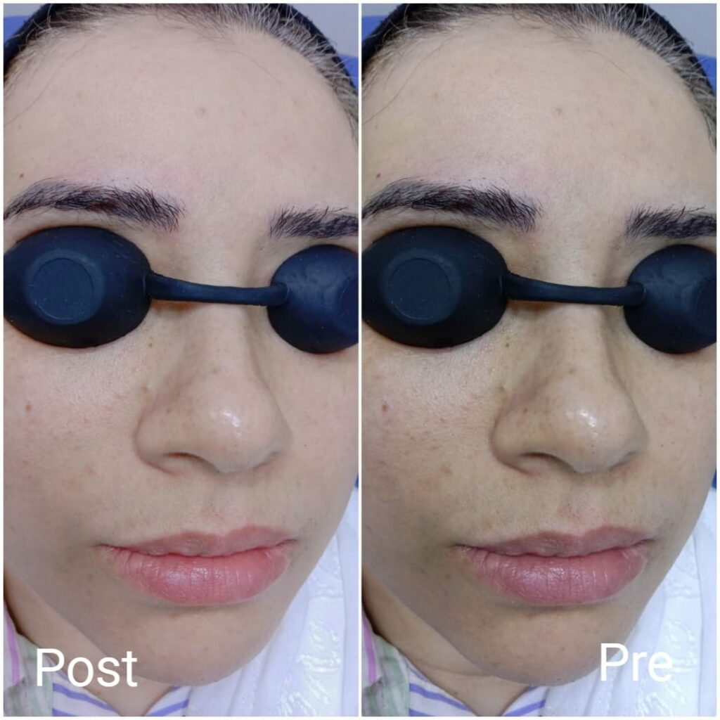 Carbon laser lightening session for the face and lips